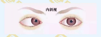 什么是調(diào)節(jié)性內(nèi)斜視？