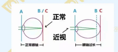 哪個(gè)年齡近視度數(shù)最容易增長(zhǎng)？