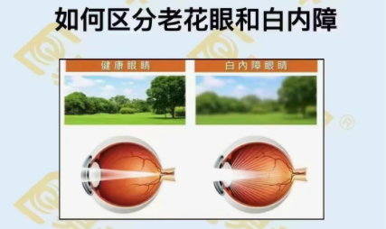 如何區(qū)分老花眼和白內障？